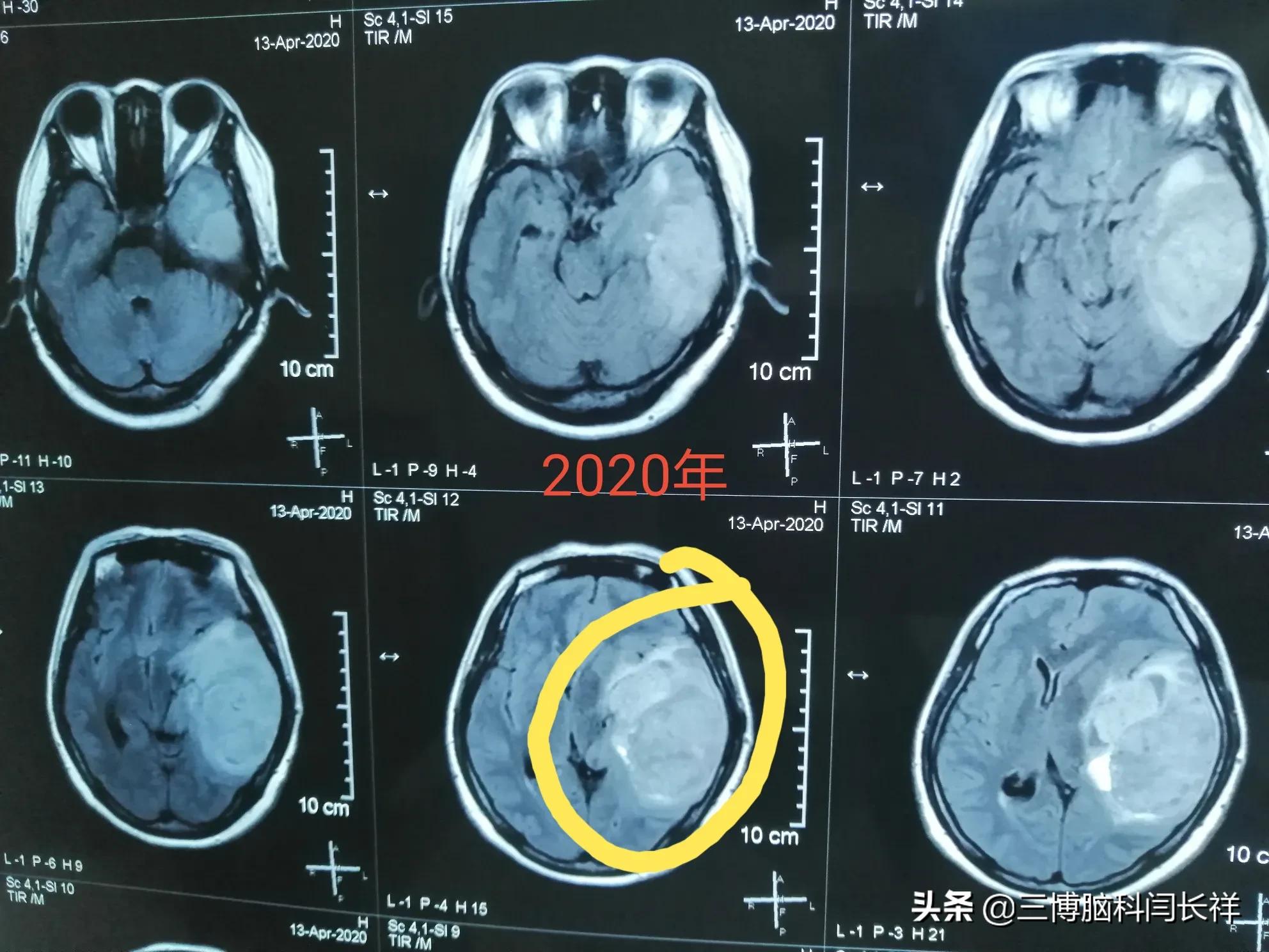 腦瘤患者千萬別聽嚇唬以免耽誤最佳治療時機