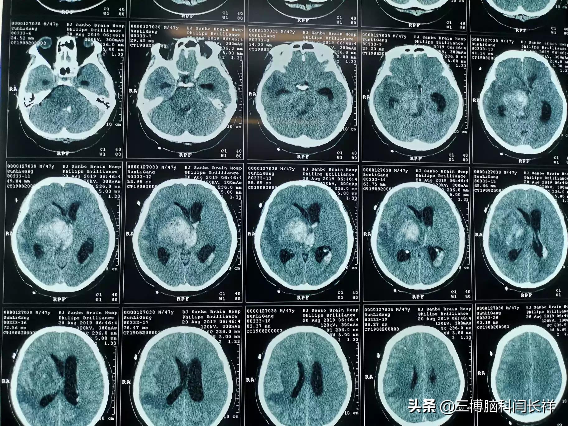 丘脑胶质瘤该不该治疗?该如何治疗?