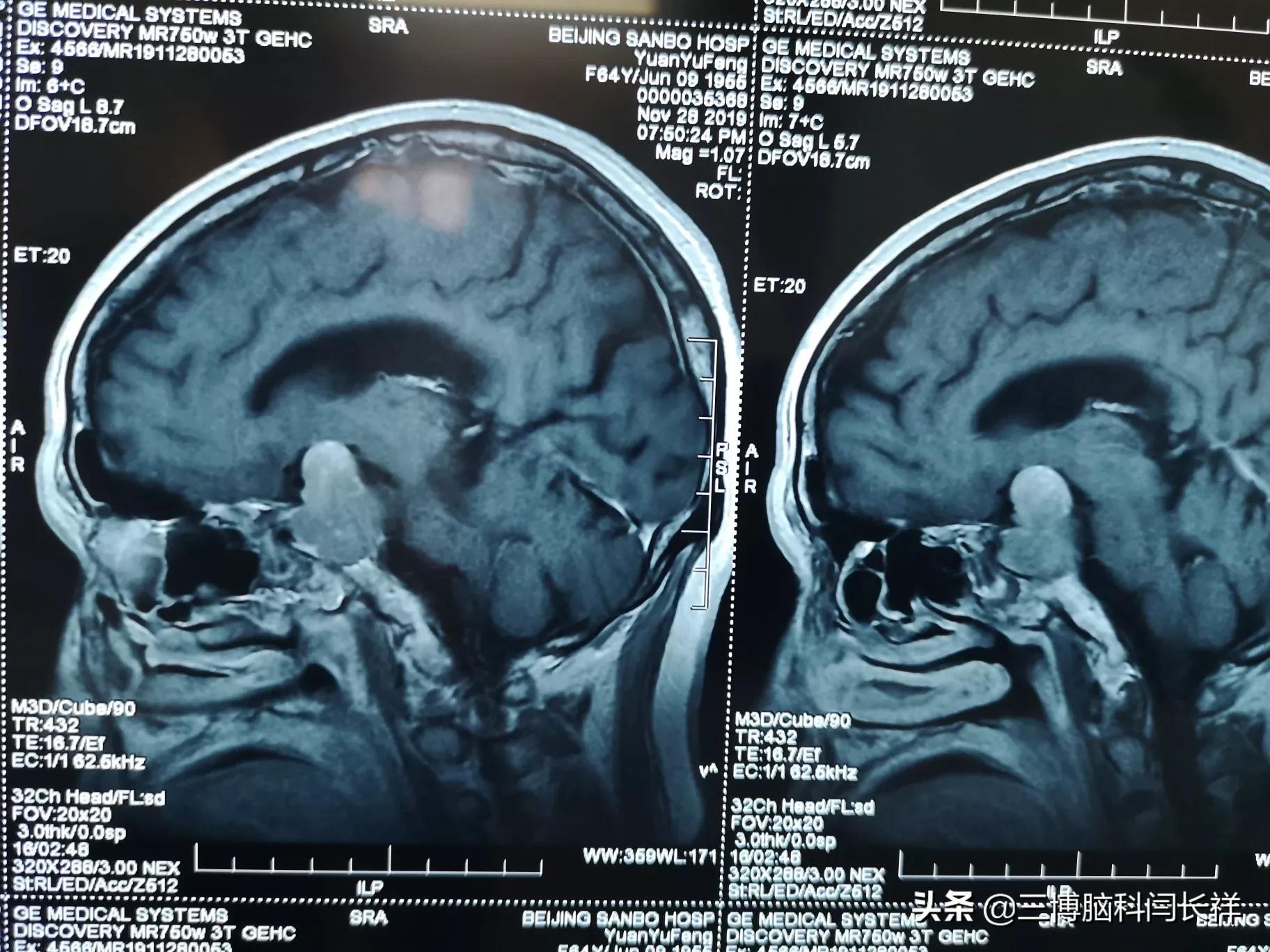 脑垂体瘤患者图片 得脑垂体瘤的面部图片