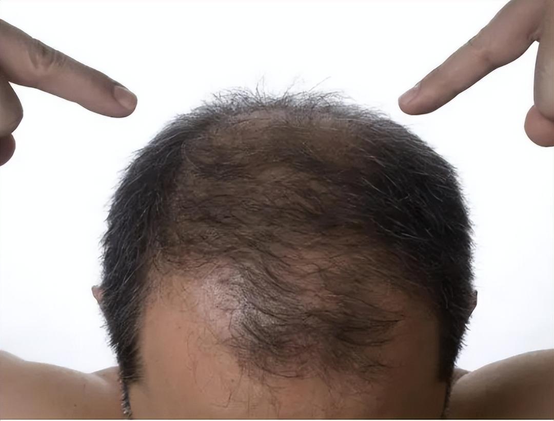 2-habits-that-speed-up-hair-loss-you-re-probably-doing-everyday-not