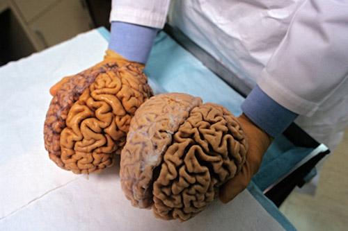 大脑褶皱或与人有多神经质相关