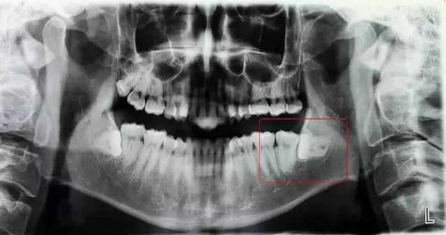 齐牙费用(整齐的牙齿标准图)