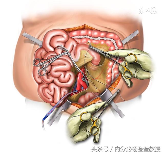 减肥手术多少钱手术吸脂40斤要多少钱