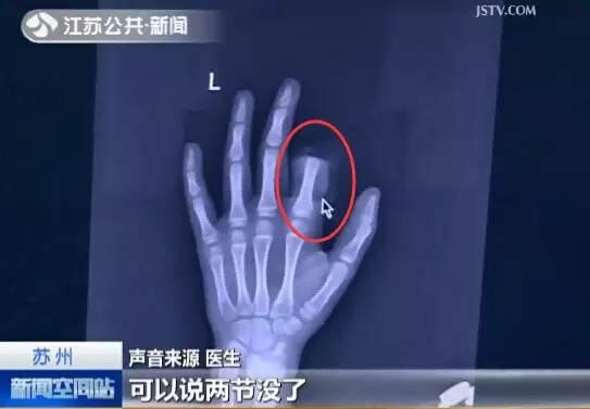 苏州12岁男孩玩手机被爸爸骂，挥刀砍断自己的手指