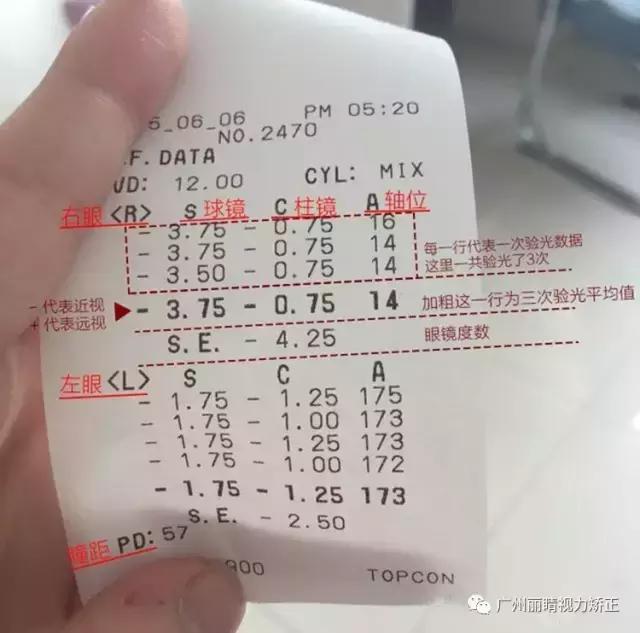 验光单se什么意思验光se代表什么意思