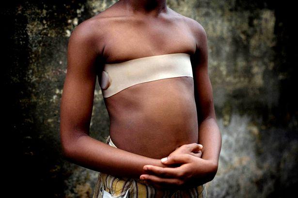 非洲女孩满十岁就必须要用炙热石头把乳房烧坏，而加害者竟是母亲