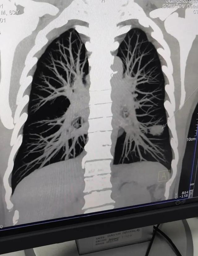肺部肿瘤手术费用(良性肿瘤切除需多少钱)