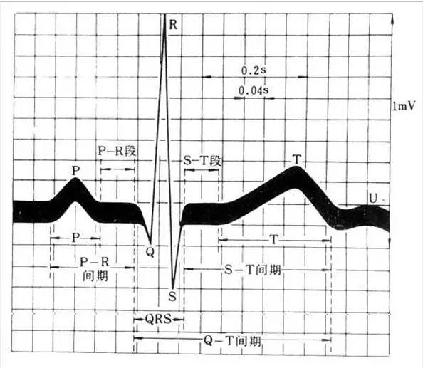 p波高尖的心电图图片