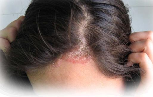 头屑比头发多怎么办？小心与这3种头皮疾病有关，很多人都不知道