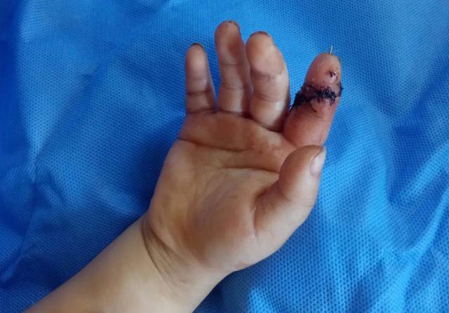 3 岁儿童食指离断，7 小时后遇到「对的人」