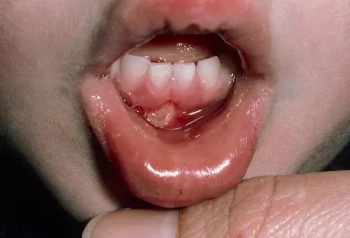 舌头根部溃疡图片