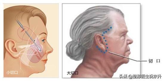 6个快问快答，给想做"拉皮手术"的人一些真实的建议