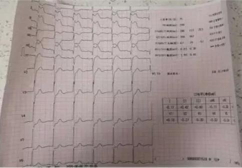 阜阳市妇女儿童医院胸痛中心成功救治 83 岁高龄急性心肌梗死患者