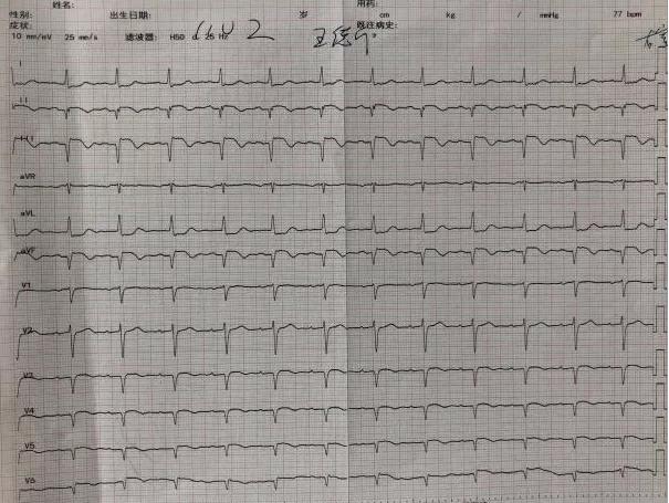 阜阳市妇女儿童医院胸痛中心成功救治 83 岁高龄急性心肌梗死患者