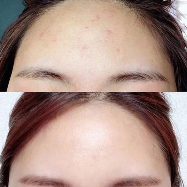 口罩下痘痘频频冒出？唯诺雅来拯救来自“痘星”的你