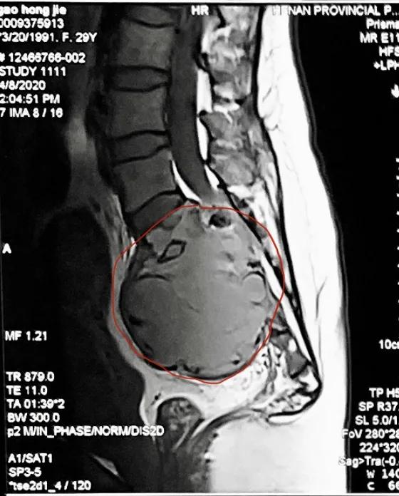 29 岁姑娘，骶骨所剩无几……