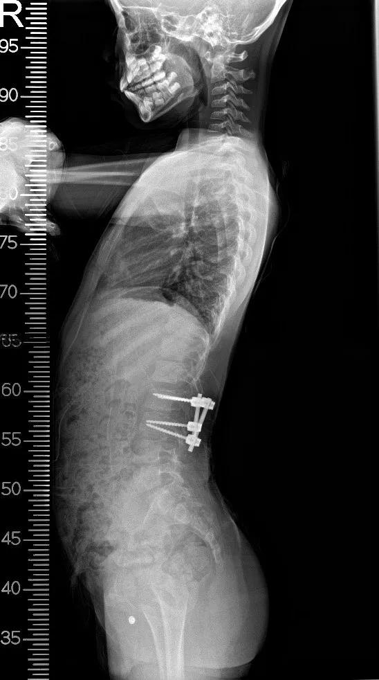 同济大学附属同济医院成功救治一例复杂儿童腰椎半椎体畸形
