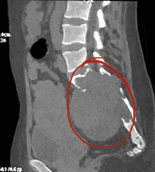 29 岁姑娘，骶骨所剩无几……