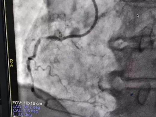 阜阳市妇女儿童医院胸痛中心成功救治 83 岁高龄急性心肌梗死患者