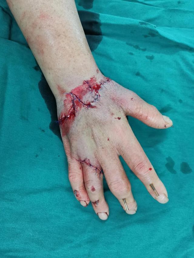 树兰杭州医院医生奋战 5 小时，断掌残垣成功再植