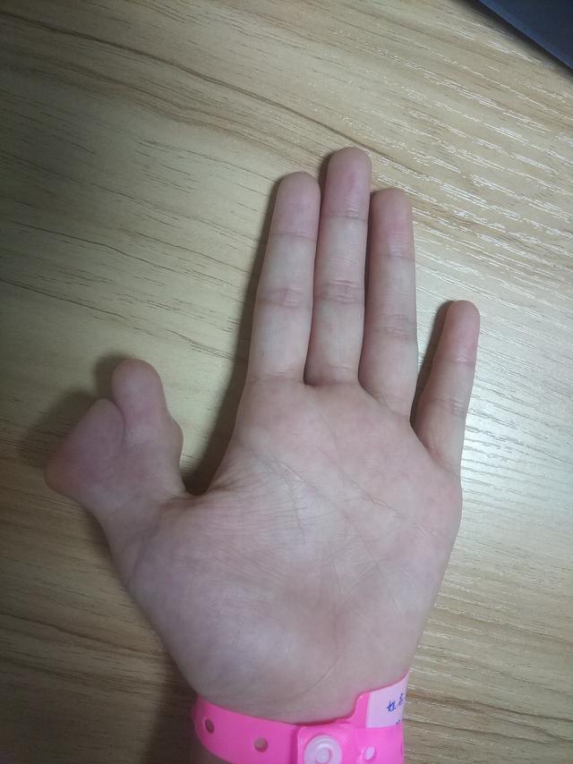 隐秘的角落:九岁患儿手上的秘密!先天性多指畸形,早治很关键
