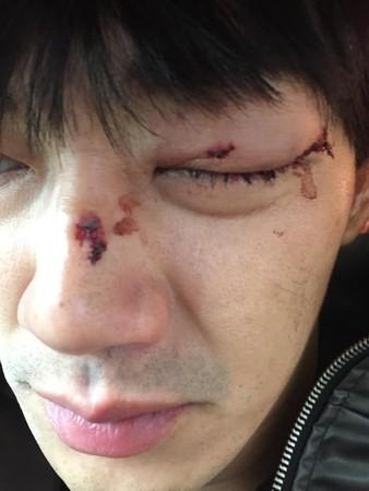 威廉拍戏出意外「视力剩0.3」！眼球遭木剑打伤……出血画面曝光