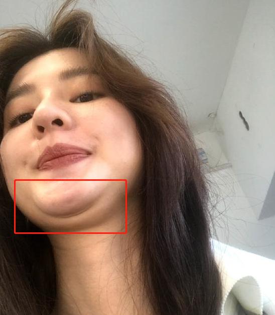 明明很瘦却有双下巴是什么原因?_隆下颏_隆下颏治疗介绍 - 好大夫在线