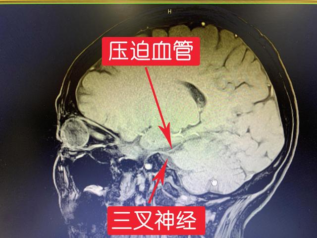 双侧<!--HAODF:8:sanchashenjingtong--><!--HAODF:8:sanchashenjingtong-->三叉神经痛<!--HAODF:/8:sanchashenjingtong--><!--HAODF:/8:sanchashenjingtong-->，微血管减压显良效