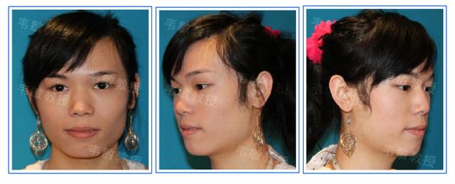 两次整形手术,让"他"成功实现男变女 - 好大夫在线