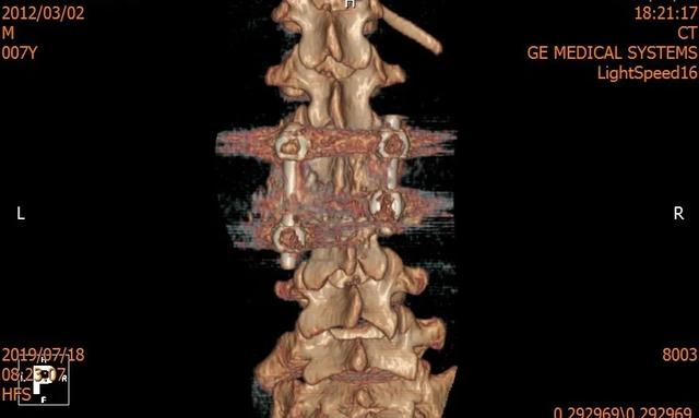 同济大学附属同济医院成功救治一例复杂儿童腰椎半椎体畸形