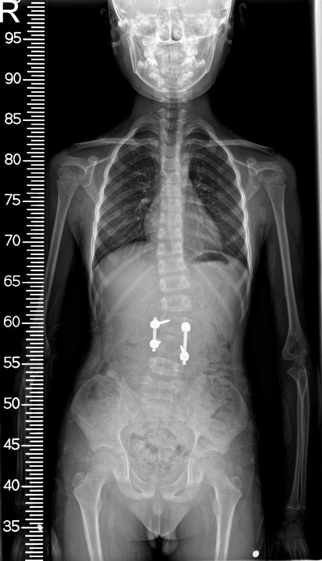 同济大学附属同济医院成功救治一例复杂儿童腰椎半椎体畸形