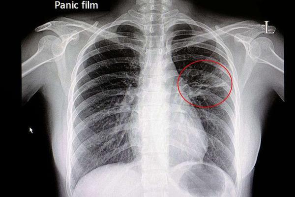 肺炎的X线表现与CT表现，有什么不同？详细分析给你看