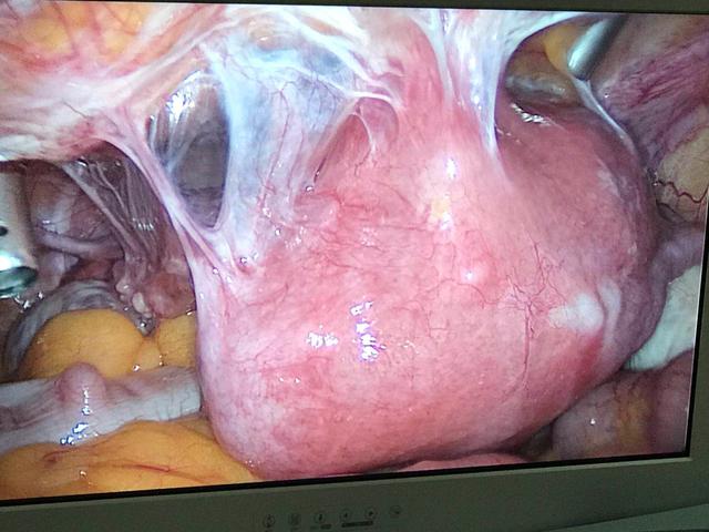 今日谈谈:腺肌症保宫手术_子宫腺肌症_子宫腺肌症治疗方式 - 好大夫