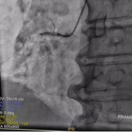 阜阳市妇女儿童医院胸痛中心成功救治 83 岁高龄急性心肌梗死患者