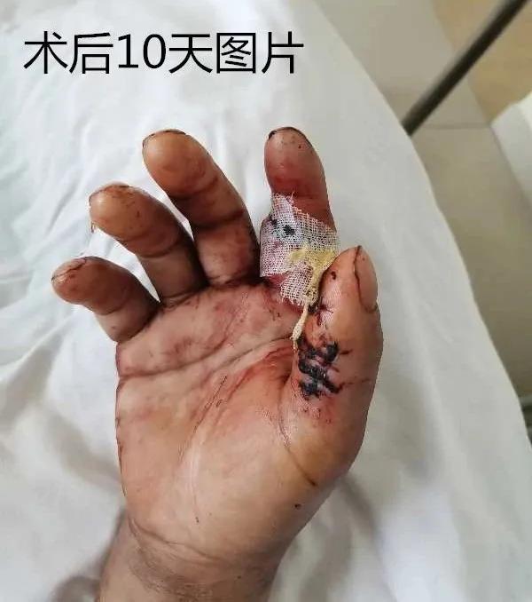 蓟州区人民医院成功实施断指再植手术，手指奇迹「复活」