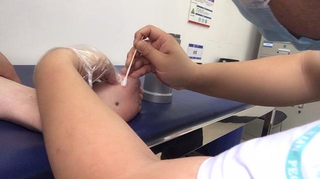 疣冷冻多少钱(冷冻治疗疣一次多少钱)