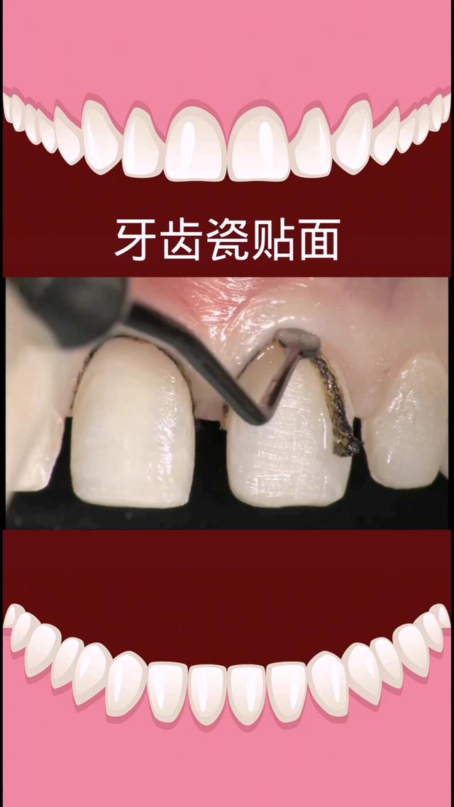 贴面流程(牙齿贴面流程)