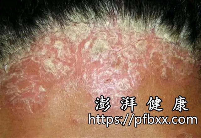 the-red-spots-on-the-head-are-covered-with-thick-skin-no-pain-no