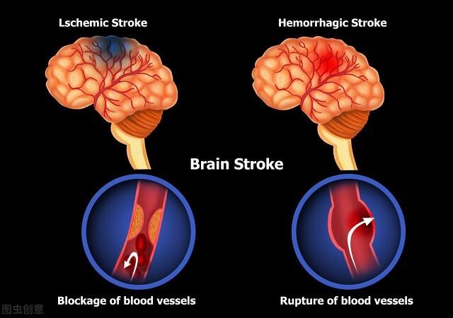 High Compression Stroke How closely are high blood pressure and stroke related?In addition to ...