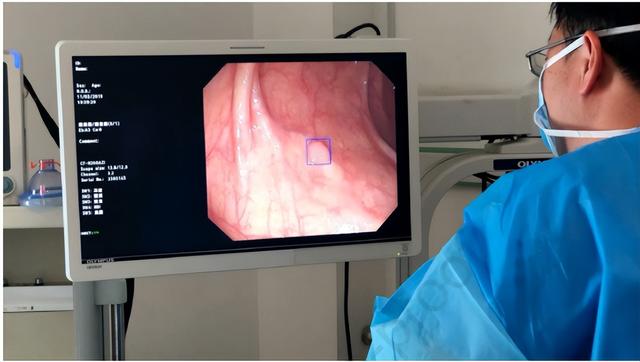 Ai-assisted Colonoscopy Outperforms Conventional Colonoscopy In Adenoma 