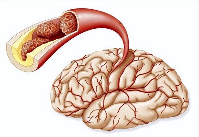 What Is The Cause Of Recurrent Cerebral Infarction INEWS