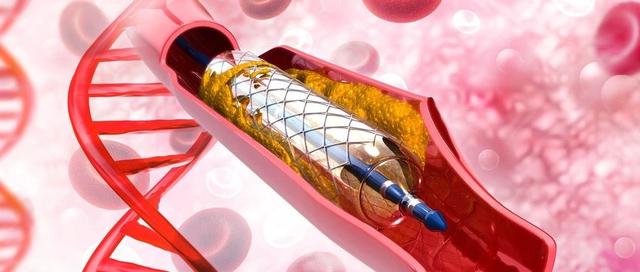 Drug-eluting stents for coronary heart disease, can ACC/AHA lesion ...