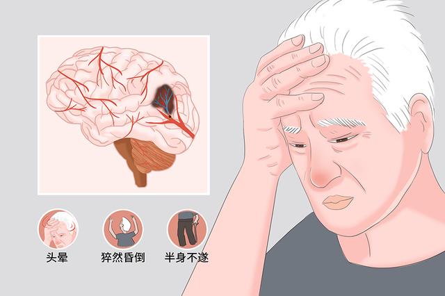 what-are-the-symptoms-of-cerebral-infarction-sequelae-inews