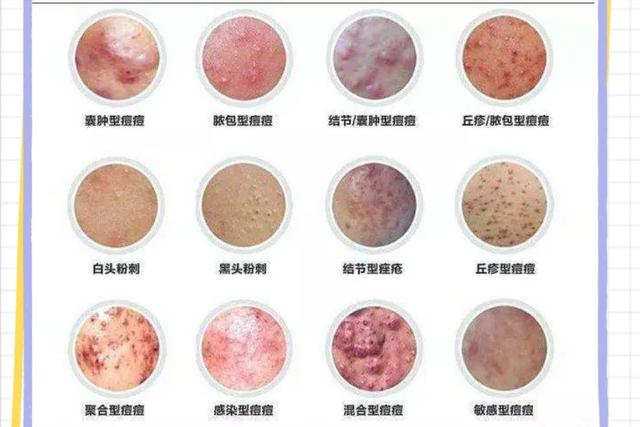 Dermatologists tell you: why are acne more and more? - iNEWS
