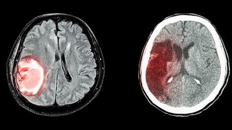 脑梗死病人饮食应注意哪些