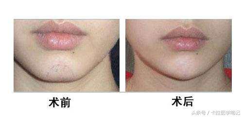 假体垫下巴后多久恢复自然?