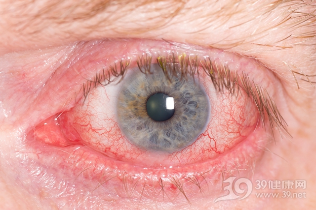 眼睛发“红”不能忽视，当心是这些疾病作祟！
