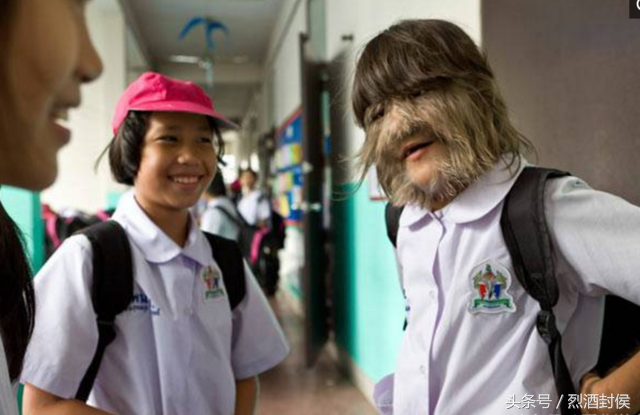 一个患有多毛症的泰国姑娘，头上脸上长满了毛