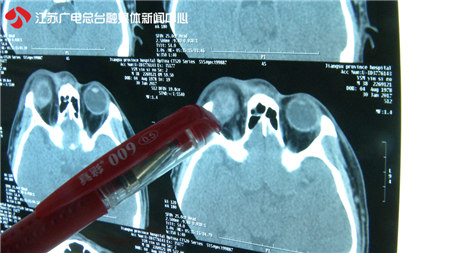 南京一医院收治多名遭烟花爆竹被炸伤眼睛患者