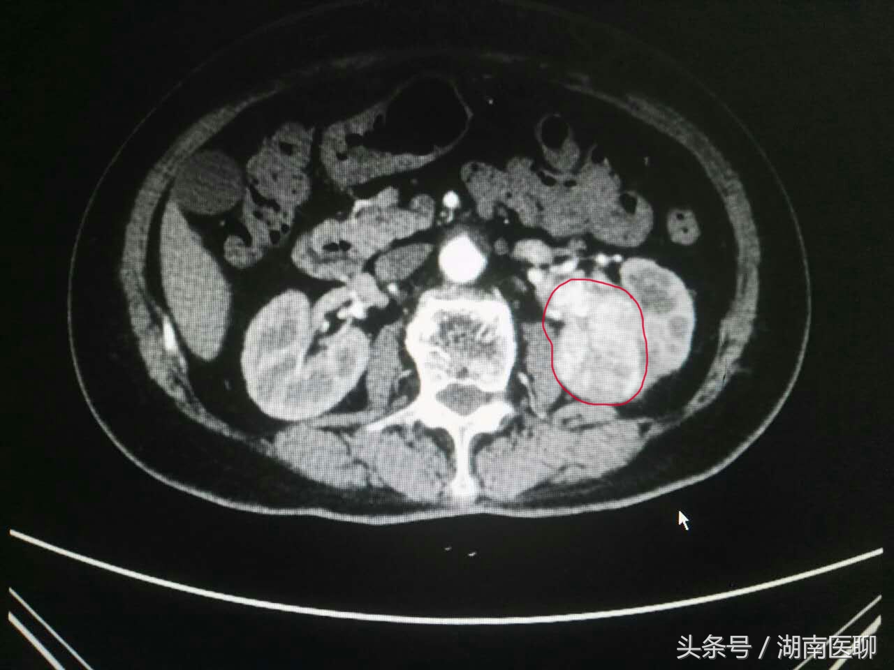 八旬老妇“见红” 竟是血尿，肾癌在作怪！